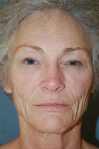 Face Lift and Neck Lift Patient 89542 Before Photo # 1