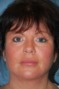 Face Lift and Neck Lift Patient 15871 After Photo # 2