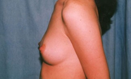 Breast Augmentation Patient 35218 Before Photo # 3
