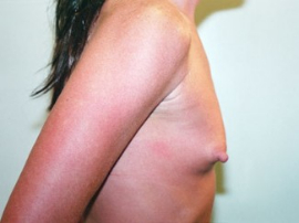 Breast Augmentation Patient 43878 Before Photo # 3