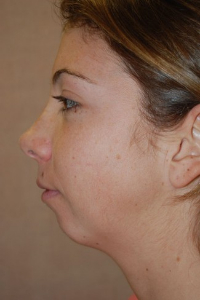 Chin Augmentation Patient 79295 Before Photo # 1