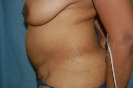 Liposuction Patient 62658 Before Photo # 5