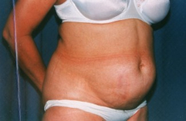 Tummy Tuck Patient 19101 Before Photo # 1