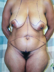 Breast Lift Patient 62255 Before Photo # 3