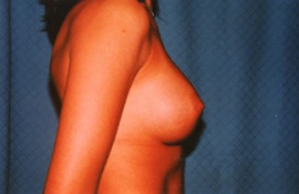 Breast Augmentation Patient 71703 After Photo # 6