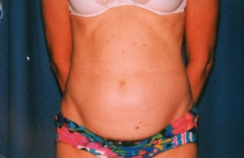 Tummy Tuck Patient 65833 Before Photo # 1