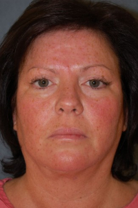 Eye Lift - Blepharoplasty Patient 60760 Before Photo # 1