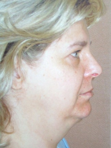 Eye Lift - Blepharoplasty Patient 37019 Before Photo # 1