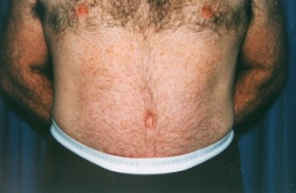 Tummy Tuck - Men Patient 44902 After Photo # 2