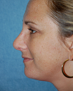 Rhinoplasty Patient 70122 After Photo # 6