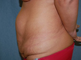 Body Lift Patient 56396 Before Photo # 5