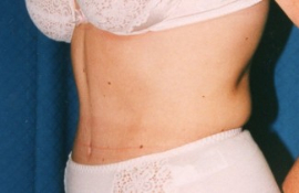 Tummy Tuck Patient 15918 After Photo # 4