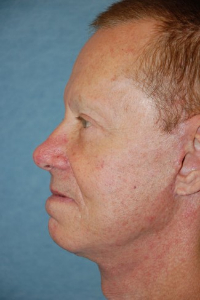 Facial Surgery - (Men) Patient 29963 After Photo # 4