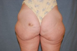 Body Lift Patient 69575 Before Photo # 1