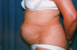 Tummy Tuck Patient 19101 Before Photo # 5