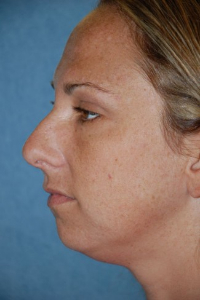 Chin Augmentation Patient 27625 Before Photo # 3