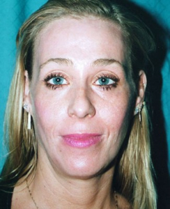 Eye Lift - Blepharoplasty Patient 37904 After Photo # 4