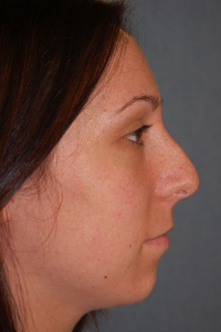 Chin Augmentation Patient 68370 Before Photo # 7