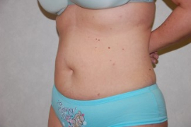 Liposuction Patient 79601 After Photo # 4