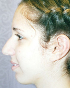 Chin Augmentation Patient 37617 Before Photo # 1