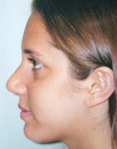 Rhinoplasty Patient 10829 After Photo # 2