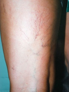 Leg Vein Correction Patient 60238 Before Photo # 1