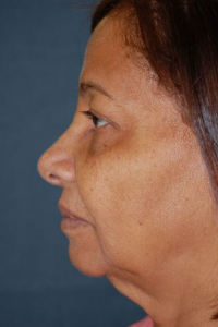 Face Lift and Neck Lift Patient 43313 Before Photo # 5