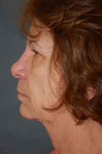 Face Lift and Neck Lift Patient 18954 Before Photo # 5