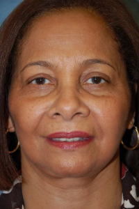 Face Lift and Neck Lift Patient 43313 After Photo # 2