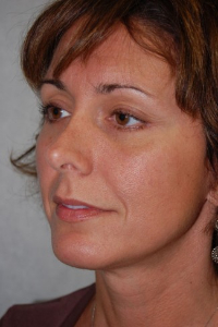 Chin Augmentation Patient 83833 After Photo # 2