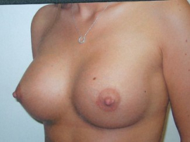 Breast Augmentation Patient 45178 After Photo # 2