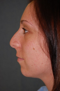 Chin Augmentation Patient 68370 Before Photo # 3
