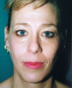 Eye Lift - Blepharoplasty Patient 37904 Before Photo # 3