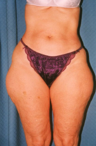 Liposuction Patient 37667 Before Photo # 1