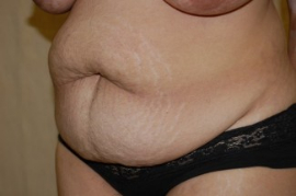 Tummy Tuck Patient 56117 Before Photo # 3