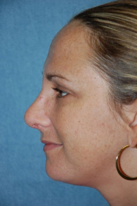 Chin Augmentation Patient 27625 After Photo # 4