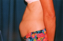 Tummy Tuck Patient 65833 Before Photo # 5