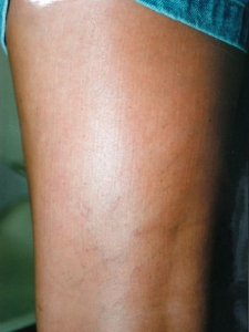 Leg Vein Correction Patient 60238 After Photo # 2