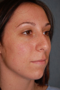 Chin Augmentation Patient 68370 Before Photo # 5