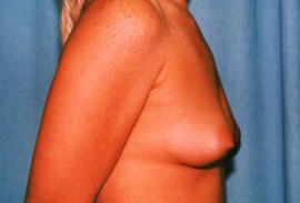 Breast Augmentation Patient 14400 Before Photo # 3