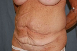 Body Lift Patient 42627 Before Photo # 3
