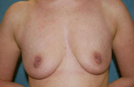 Breast Augmentation and Lift Patient 37400 Before Photo # 5