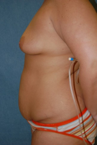 Tummy Tuck Patient 46408 Before Photo # 5
