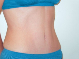 Mini Tummy Tuck Patient 74818 After Photo # 2