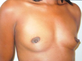 Breast Augmentation Patient 17556 Before Photo # 1
