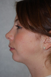 Chin Augmentation Patient 79295 After Photo # 2