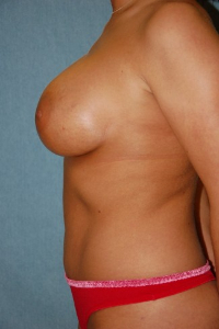 Tummy Tuck Patient 90559 After Photo # 6
