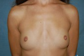 Breast Augmentation Patient 28565 Before Photo # 1