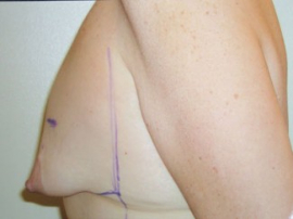 Breast Augmentation and Lift Patient 31680 Before Photo # 3