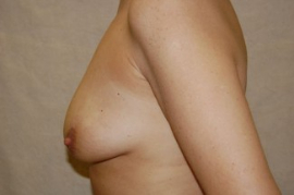 Breast Augmentation Patient 44021 Before Photo # 3